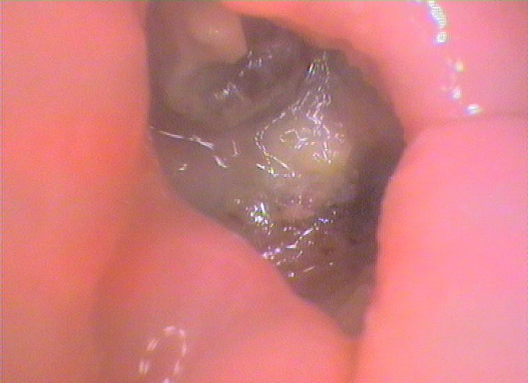 infected socket after extraction