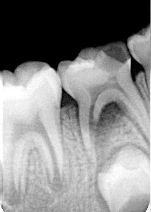 xray of baby teeth