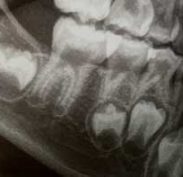 Teeth forming in bone with Enamel Whiter coating layer over rest of tooth in a Sac