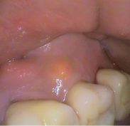 Large bony exostosis extending along the check side of the maxilla (upper jaw bone) pushing away the cheek. There is another exostosis on the exostosis, looking like a pink lump. It is next to an abscess which is yellow and soft compared to the very firm & hard exostosis.