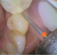 Preparing the Tooth with a High-Speed Drill with Suction