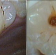 To seal, once started to clean fissure, decay in the dentine was found